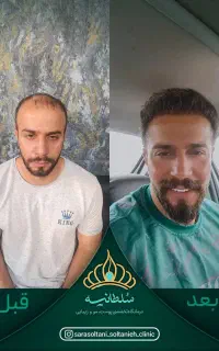 کاشت مو پر تراکم با طراحی خط رویش مو