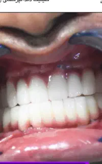 مرکزفوق تخصصی ایمپلنت دیجیتال/فوری/سبک کاخ لبخند
