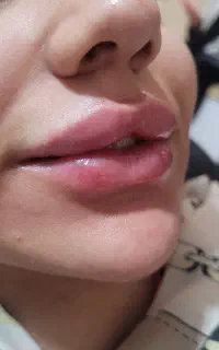 آموزش ژل بوتاکس فیلر بادی کاشتمو نخ ساکشن چربی