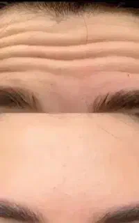 بوتاکس و زیبایی صورت