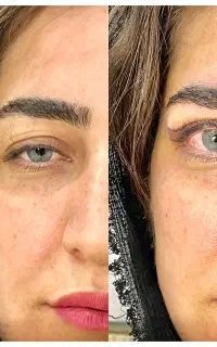 تخفیف بلفا‌گربه ای و ساکشن غبغب توسط پزشک زیبایی