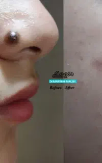 برداشتن بدون درد خال و زگیل
