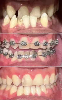 جشنواره ویژه ارتودنسی ۲۴  توسط متخصص