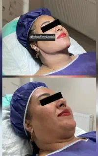 ساکشن غبغب سوپرکانتورینگ