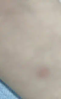 خال، زگیل