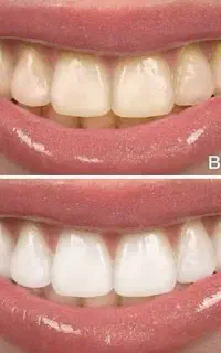 جشنواره بلیچینگ و زیبایی دندان ها