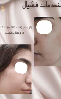فشیال و پاکسازی پوست