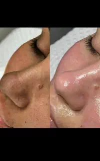 لیزر موهای زاید،پاکسازی و فشیال پوست