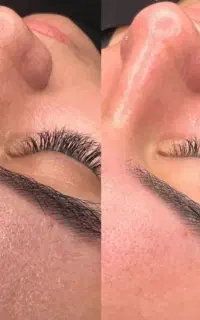 پاکسازی و فیشال در کلینیک
