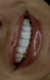 کامپوزیت دندان اقساطی فقط تا ۳شنبه