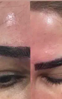 ژل بوتاکس اقساط