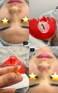 تخفیف فیشال و پاکسازی پوست