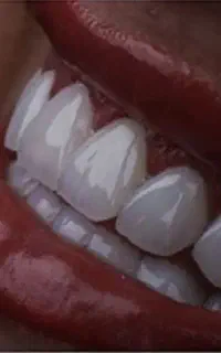 لبخند کامل سفید صدفی با قیمت اعحاب آور بمدت سه روز