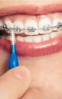 تخفیف ویژه ارتودنسی با قیمت قبل ویژه مدارس
