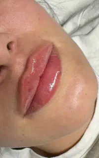 تزریق فیلر و بوتاکس  جشنولره پاییزی