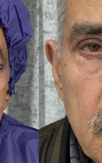 بلفاروپلاستی تضمینی چشم با پزشک مجرب