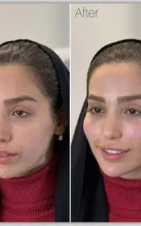 فول فیس فقط۷۹۰۰+بوتاکس فقط ۶۵۰ در مطب پزشک