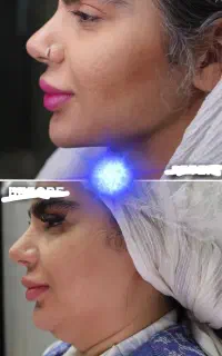 جشنواره ساکشن شکم و پهلو و غبغب