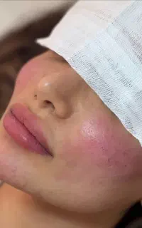 جشنواره تخفیفی فیلر وبوتاکس