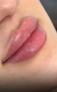 زیبایی نچرال، ژل و بوتاکس و لیزر