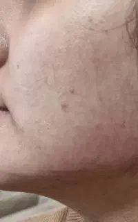 تزریق فیلر ده سی سی درموفیل مناسب کانتورینگ صورت