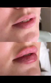 جشنواره ژل و بوتاکس و پی ار پی