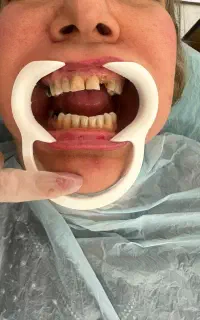 اموزش بریچ لیزری وکامپوزیت