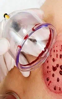 طب سنتی ، حجامت بادکش و تزریقات