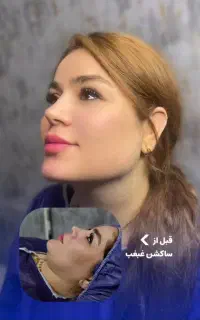 ساکشن غبغب بلفارو پلاستی لیفت ابرو