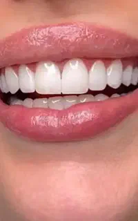 کامپوزیت دندان