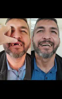 ساخت دندان مصنوعی با نازلترین قیمت و بهترین کیفیت