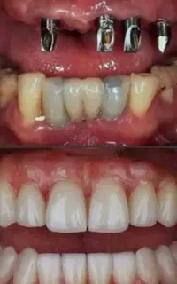 خدمات تخصصی ایمپلنت