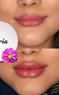 افرتزریقات ژل و بوتاکس