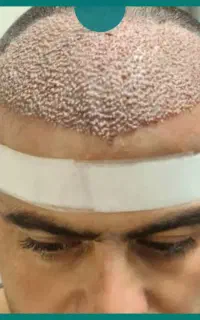 کاشت ابرو،مو و ریش با تخفیف ویژه