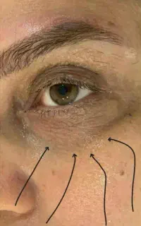 کرم بیوممتیک دور چشم
