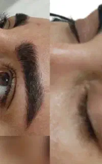 میکروپیگمنتیشن