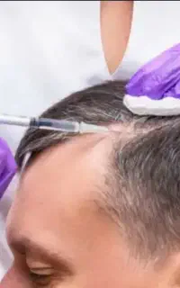 مزو تراپی مو /پی آر پی مو