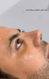 عمل بینی( راینو پلاستی)