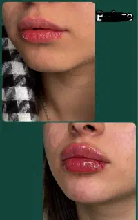 فیلر و ژل لب ، صورت و بدن ، دکتر اسدی صفا