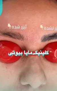 اولین مرکز تخصصی پاک کردن(ریموو)تتو ابرو،بدن مایا