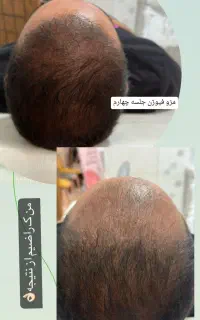 مزو تراپی پی آر پی prp مزونیدلینگ سابسیژن