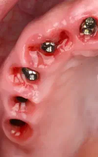 کاشت تخصصی ایمپلنت با شرایط ویژه