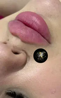 .تخفیف. تزریق ژل فیلر بوتاکس انزیم تضمینی پرسینگ