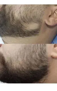 محصولات تخصصی ریزش و کم پشتی