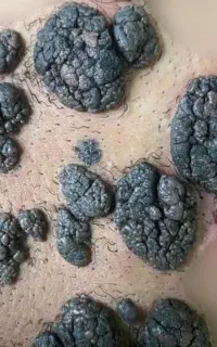 درمان ریشه ای زگیل درکمتر از ۲هفته با روش نوین
