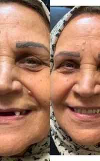 دندان مصنوعی/ دندانسازی/پروتز مصنوعی/اقساطی