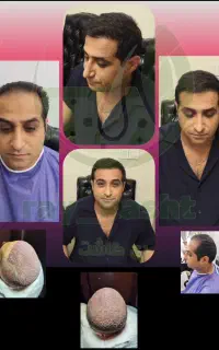 کاشت ابرو ، مو ، ریش ( ضمانت نامه کتبی )