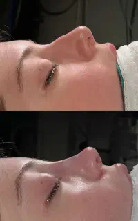 عمل زیبایی بینی با قسط ۵/۹۰۰ماهیانه