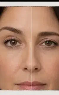 بوتاکس صورت، تزریق توسط پزشک،تخفیف محدود پنجشنبه