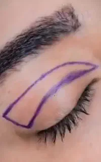 جراحی پلک نیشابور